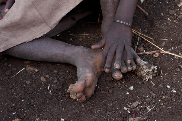 Child infected with chiggers